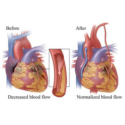 cabg-surgery